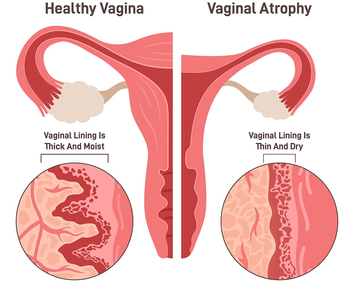 Vaginal tissue before and after — the women's health gap